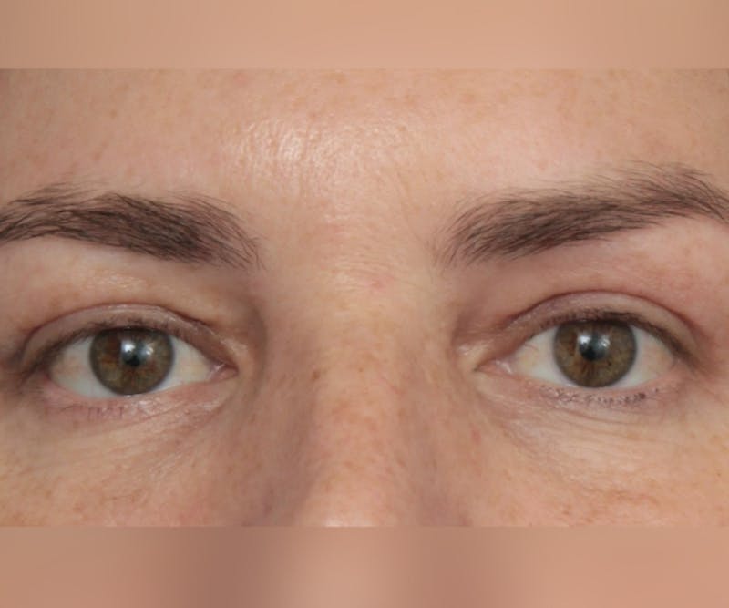 Eyelid Lift Before & After Gallery - Patient 295454 - Image 2 - Scott Chapin, MD