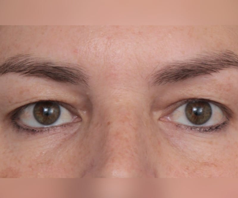 Eyelid Lift Before & After Gallery - Patient 295454 - Image 1 - Scott Chapin, MD