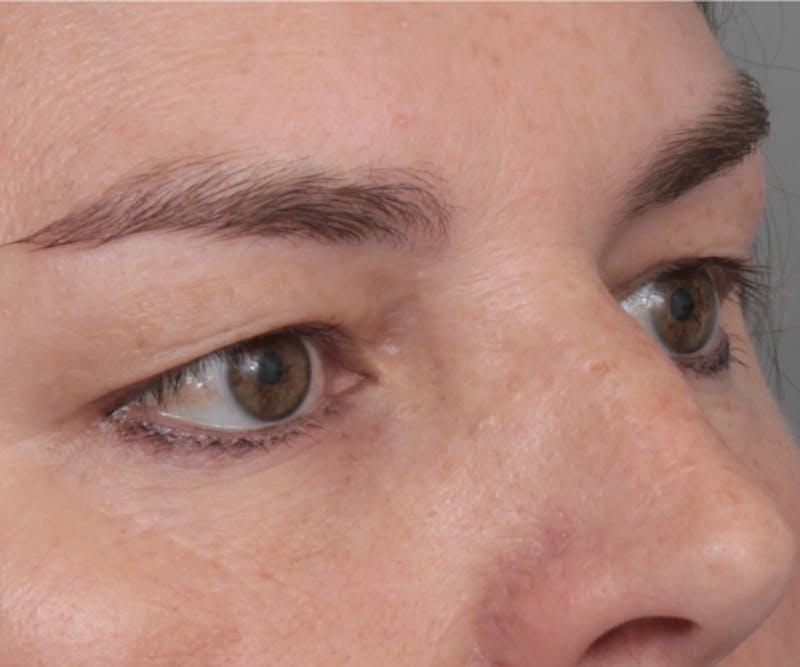 Eyelid Lift Before & After Gallery - Patient 295454 - Image 3 - Scott Chapin, MD