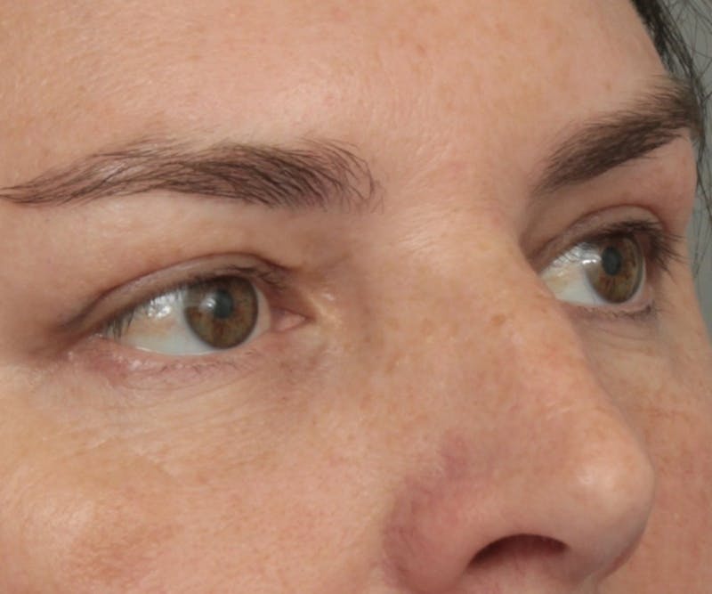 Eyelid Lift Before & After Gallery - Patient 295454 - Image 4 - Scott Chapin, MD