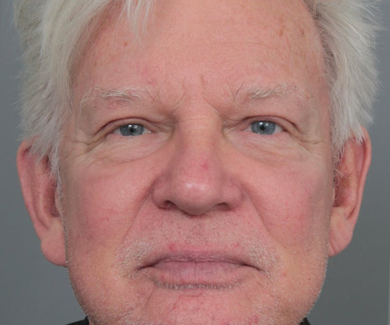 Brow Lift Before & After Gallery - Patient 200622 - Image 2 - Scott Chapin, MD