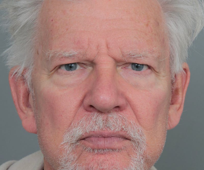 Brow Lift Before & After Gallery - Patient 200622 - Image 1 - Scott Chapin, MD