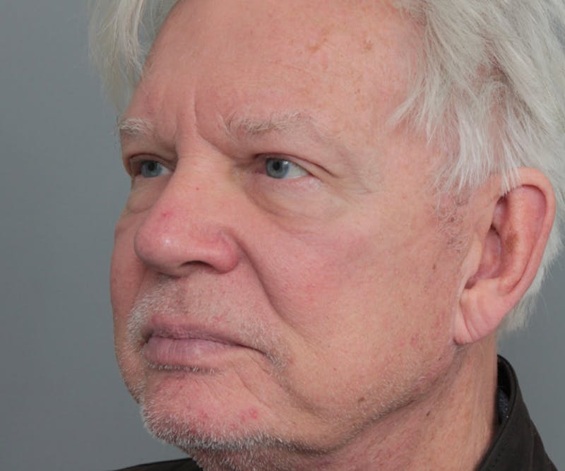 Brow Lift Before & After Gallery - Patient 200622 - Image 4 - Scott Chapin, MD