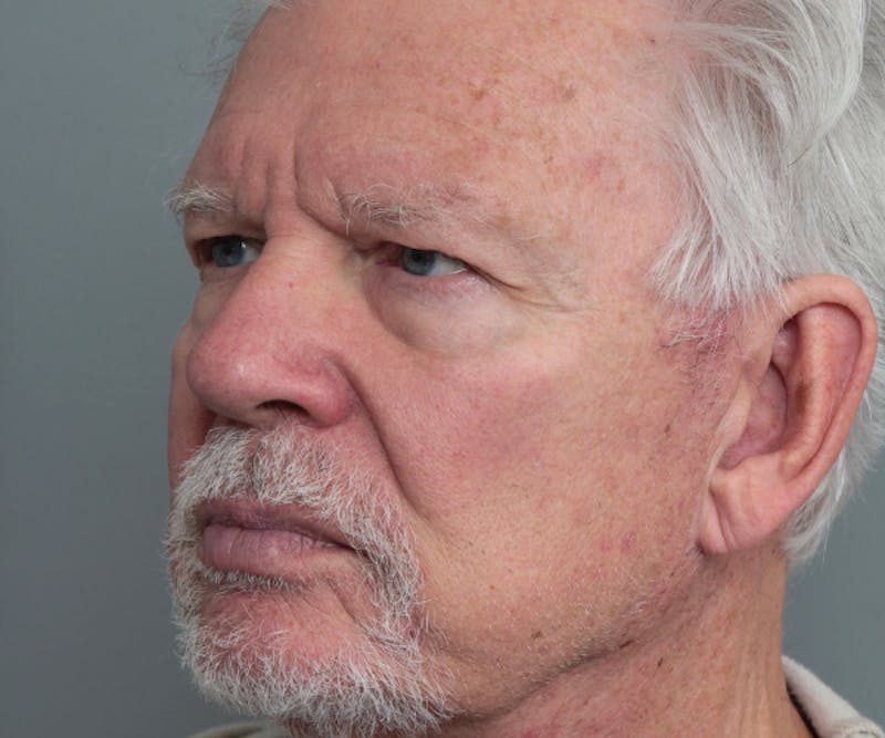 Brow Lift Before & After Gallery - Patient 200622 - Image 3 - Scott Chapin, MD