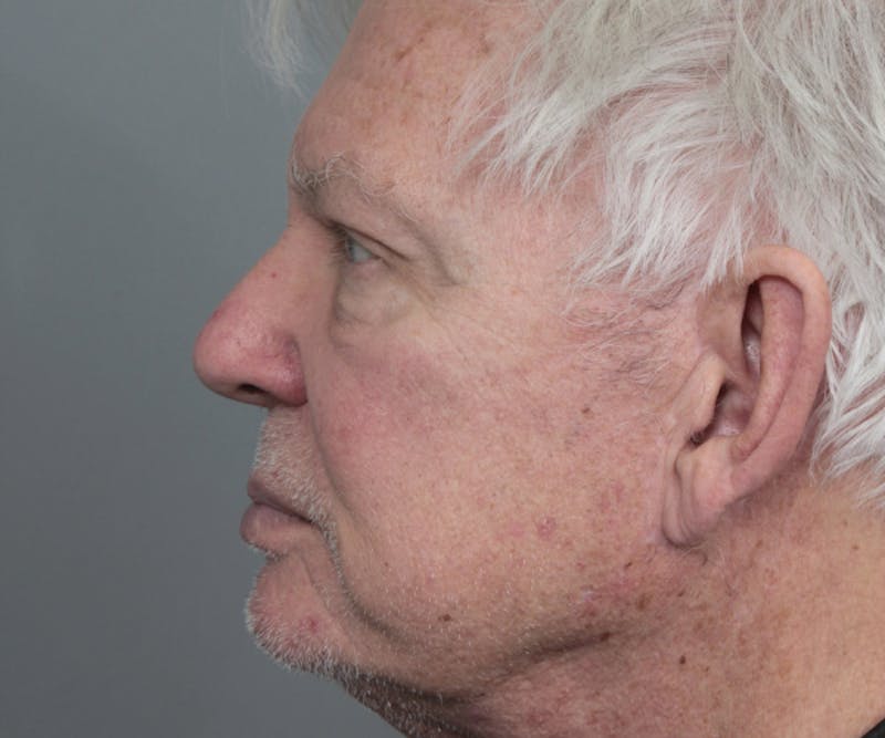 Brow Lift Before & After Gallery - Patient 200622 - Image 6 - Scott Chapin, MD