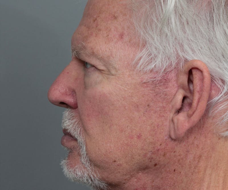 Brow Lift Before & After Gallery - Patient 200622 - Image 5 - Scott Chapin, MD