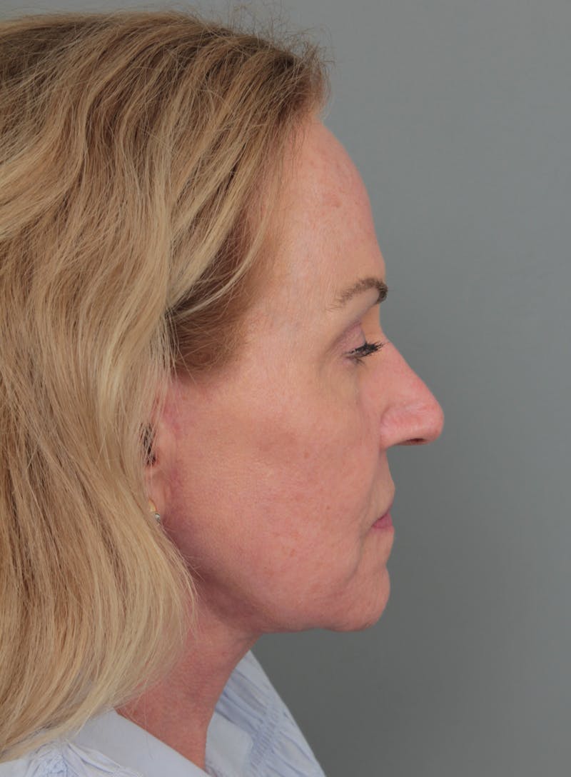 Eyelid Lift Before & After Gallery - Patient 116641 - Image 6 - Scott Chapin, MD