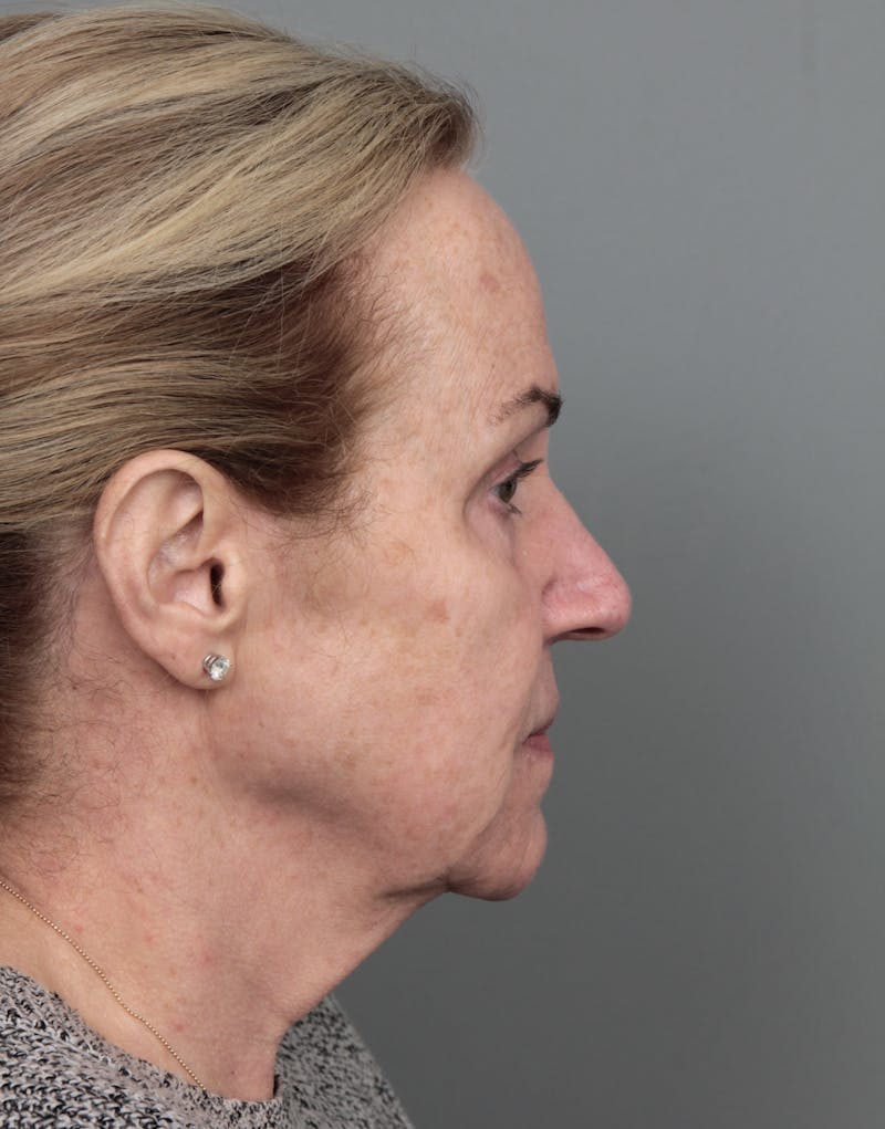 Eyelid Lift Before & After Gallery - Patient 116641 - Image 5 - Scott Chapin, MD