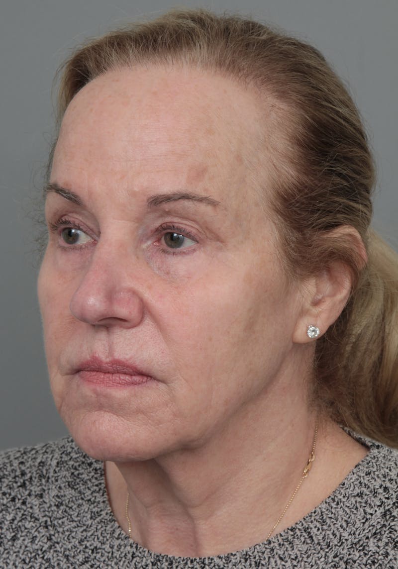 Eyelid Lift Before & After Gallery - Patient 116641 - Image 3 - Scott Chapin, MD