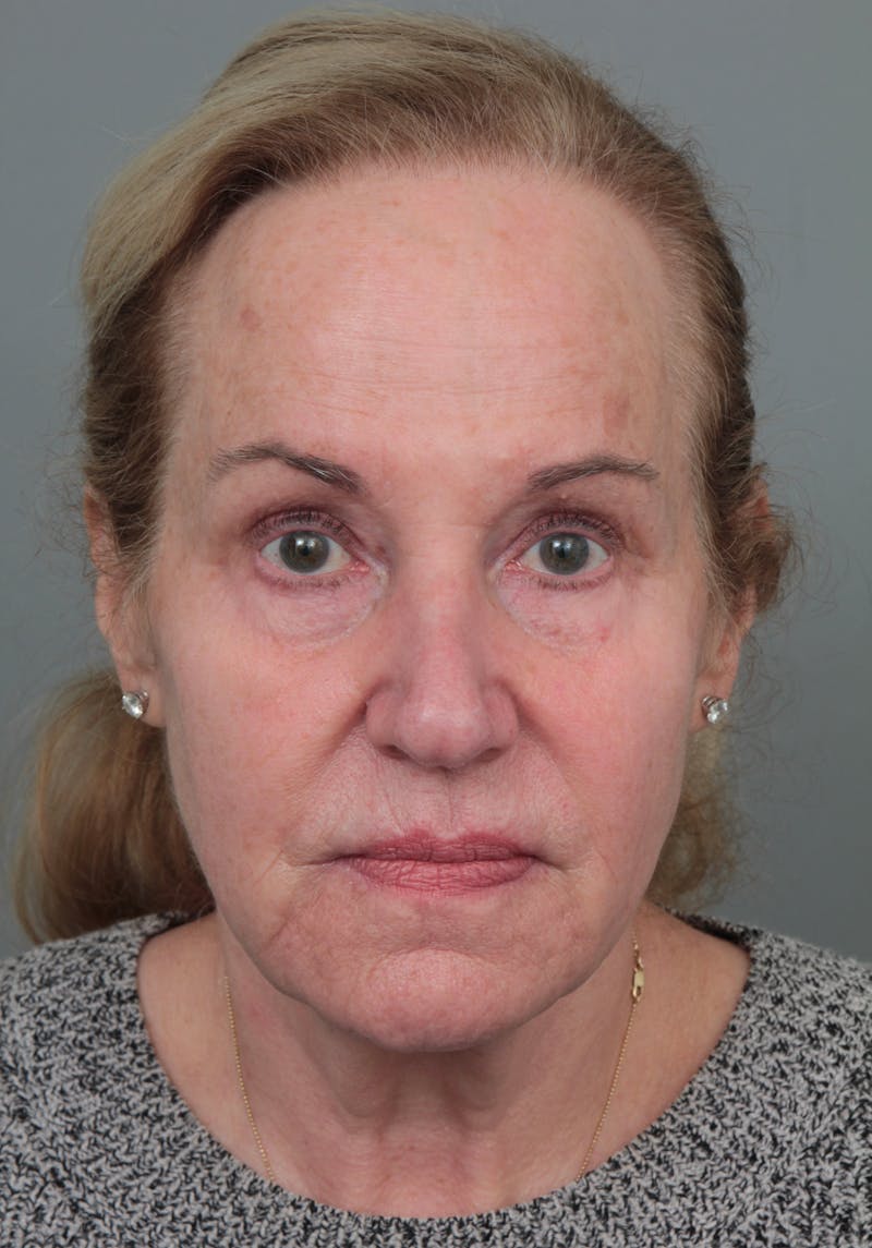 Eyelid Lift Before & After Gallery - Patient 116641 - Image 1 - Scott Chapin, MD