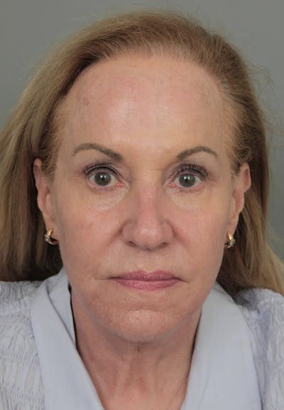 Eyelid Lift Before & After Gallery - Patient 116641 - Image 2 - Scott Chapin, MD