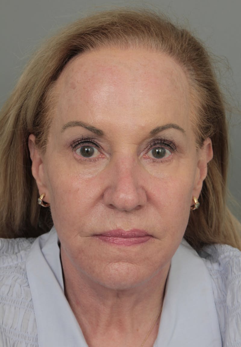 Eyelid Lift Before & After Gallery - Patient 116641 - Image 2 - Scott Chapin, MD