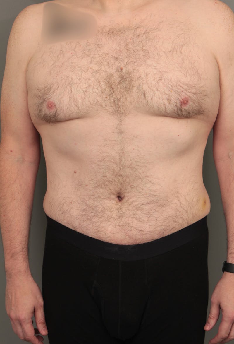 Tummy Tuck Before & After Gallery - Patient 193345 - Image 2 - Scott Chapin, MD