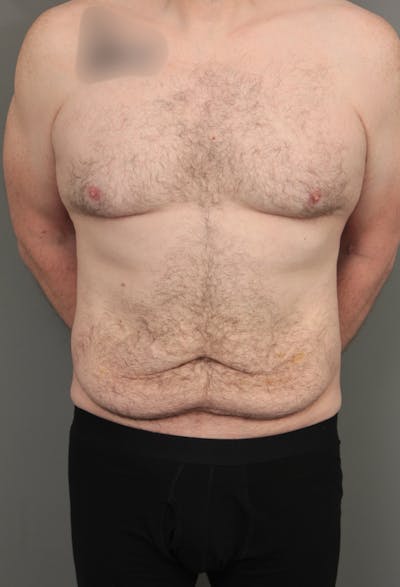 Tummy Tuck Before & After Gallery - Patient 193345 - Image 1 - Scott Chapin, MD