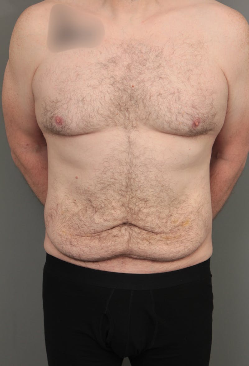 Tummy Tuck Before & After Gallery - Patient 193345 - Image 1 - Scott Chapin, MD