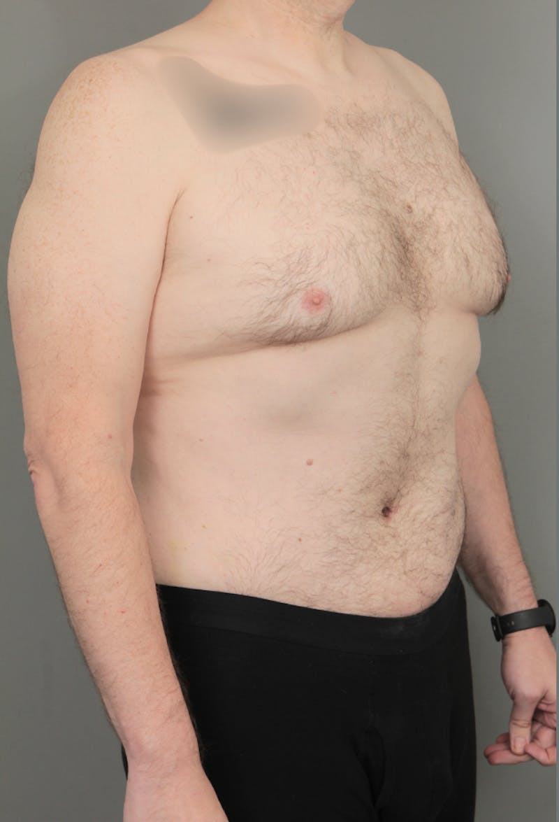Tummy Tuck Before & After Gallery - Patient 193345 - Image 4 - Scott Chapin, MD