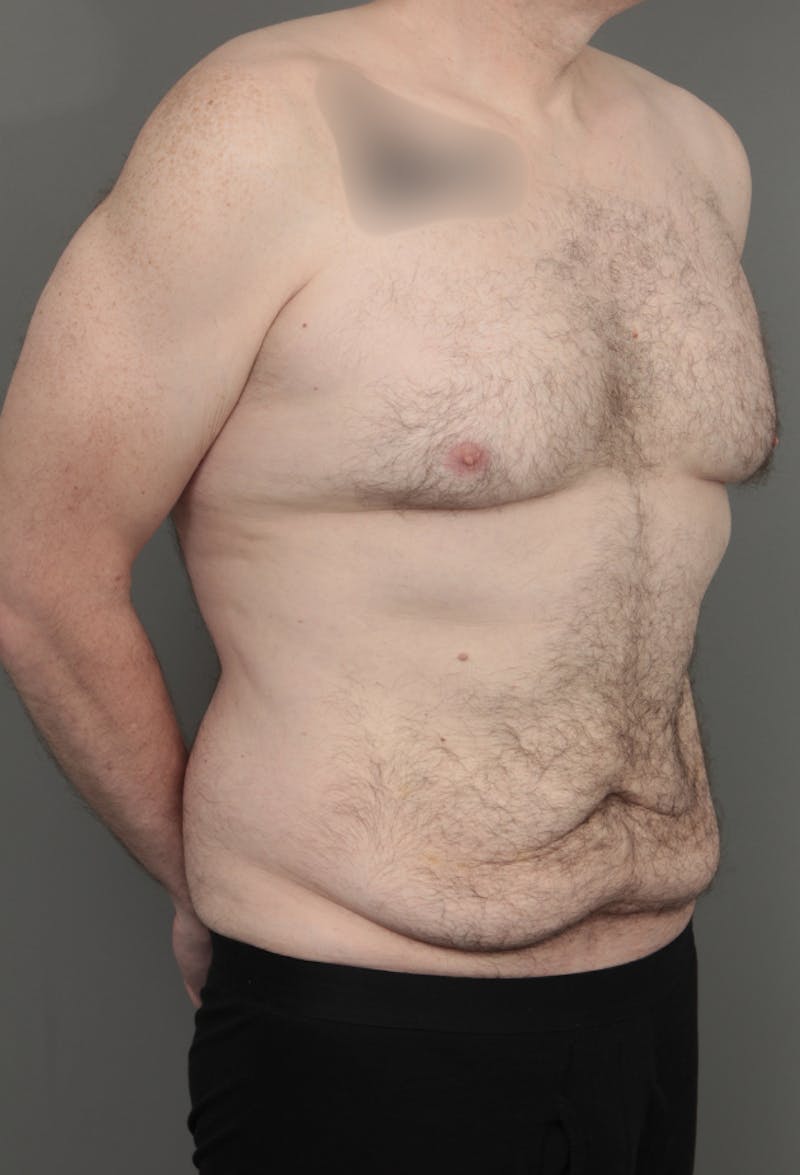 Tummy Tuck Before & After Gallery - Patient 193345 - Image 3 - Scott Chapin, MD