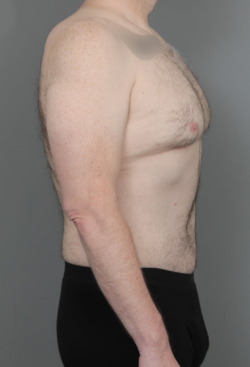 Tummy Tuck Before & After Gallery - Patient 193345 - Image 6 - Scott Chapin, MD