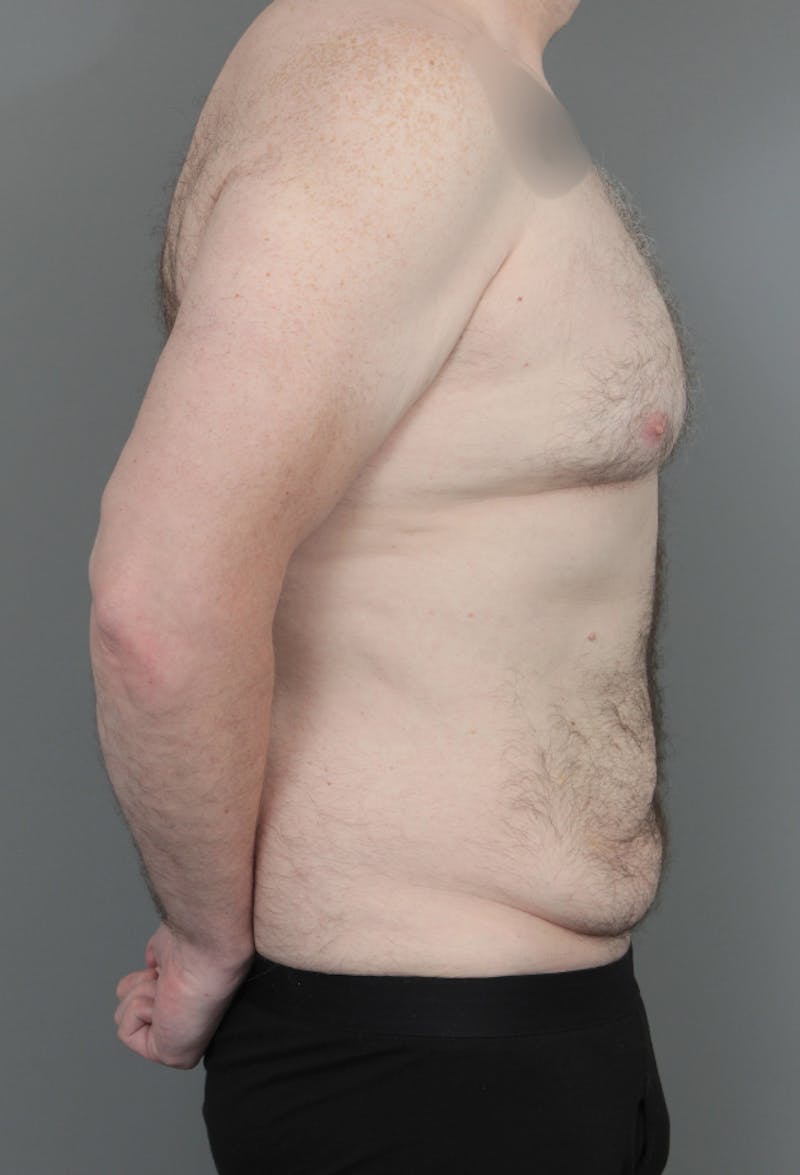 Tummy Tuck Before & After Gallery - Patient 193345 - Image 5 - Scott Chapin, MD
