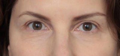 Eyelid Lift Before & After Gallery - Patient 389776 - Image 2 - Scott Chapin, MD