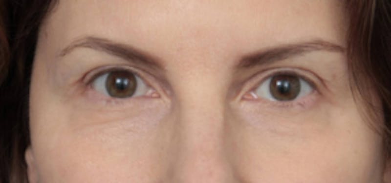 Eyelid Lift Before & After Gallery - Patient 389776 - Image 2 - Scott Chapin, MD