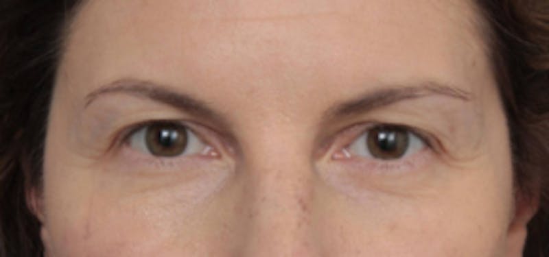 Eyelid Lift Before & After Gallery - Patient 389776 - Image 1 - Scott Chapin, MD