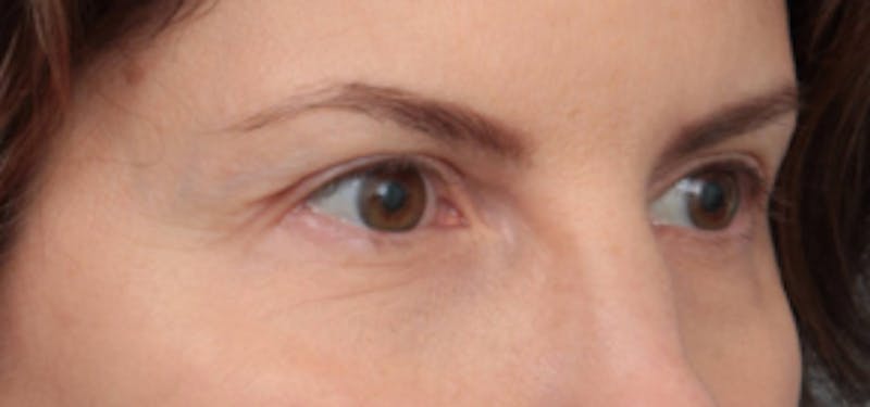 Eyelid Lift Before & After Gallery - Patient 389776 - Image 4 - Scott Chapin, MD