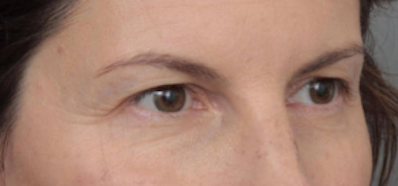 Eyelid Lift Before & After Gallery - Patient 389776 - Image 3 - Scott Chapin, MD