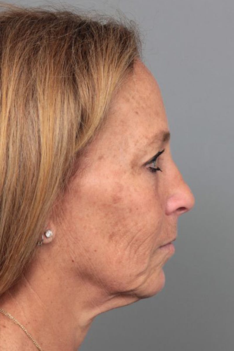 Facelift | Neck Lift Before & After Gallery - Patient 251002 - Image 3 - Scott Chapin, MD