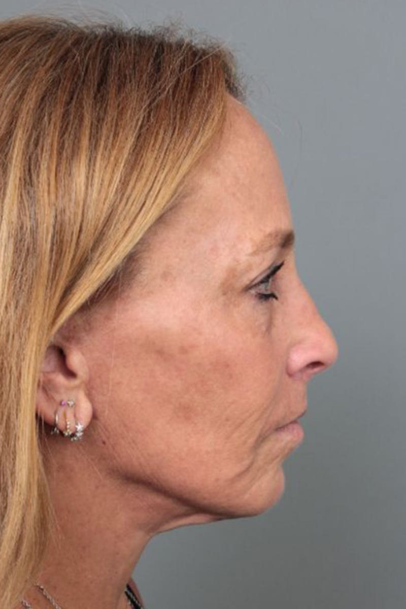 Facelift | Neck Lift Before & After Gallery - Patient 251002 - Image 4 - Scott Chapin, MD