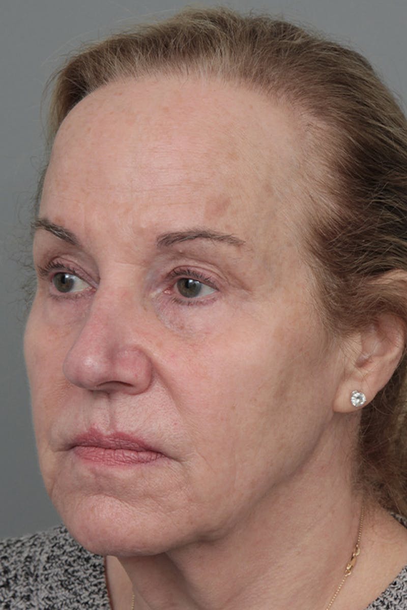 Facelift | Neck Lift Before & After Gallery - Patient 326379 - Image 1 - Scott Chapin, MD