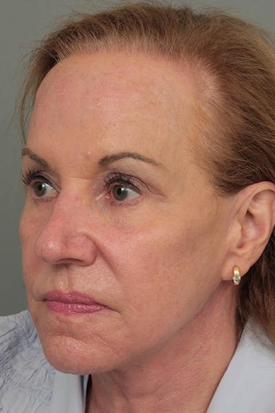 Facelift | Neck Lift Before & After Gallery - Patient 326379 - Image 2 - Scott Chapin, MD