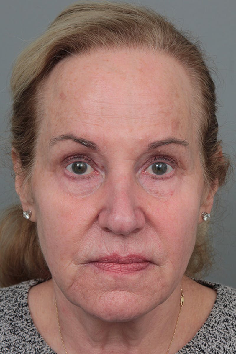 Facelift | Neck Lift Before & After Gallery - Patient 326379 - Image 3 - Scott Chapin, MD
