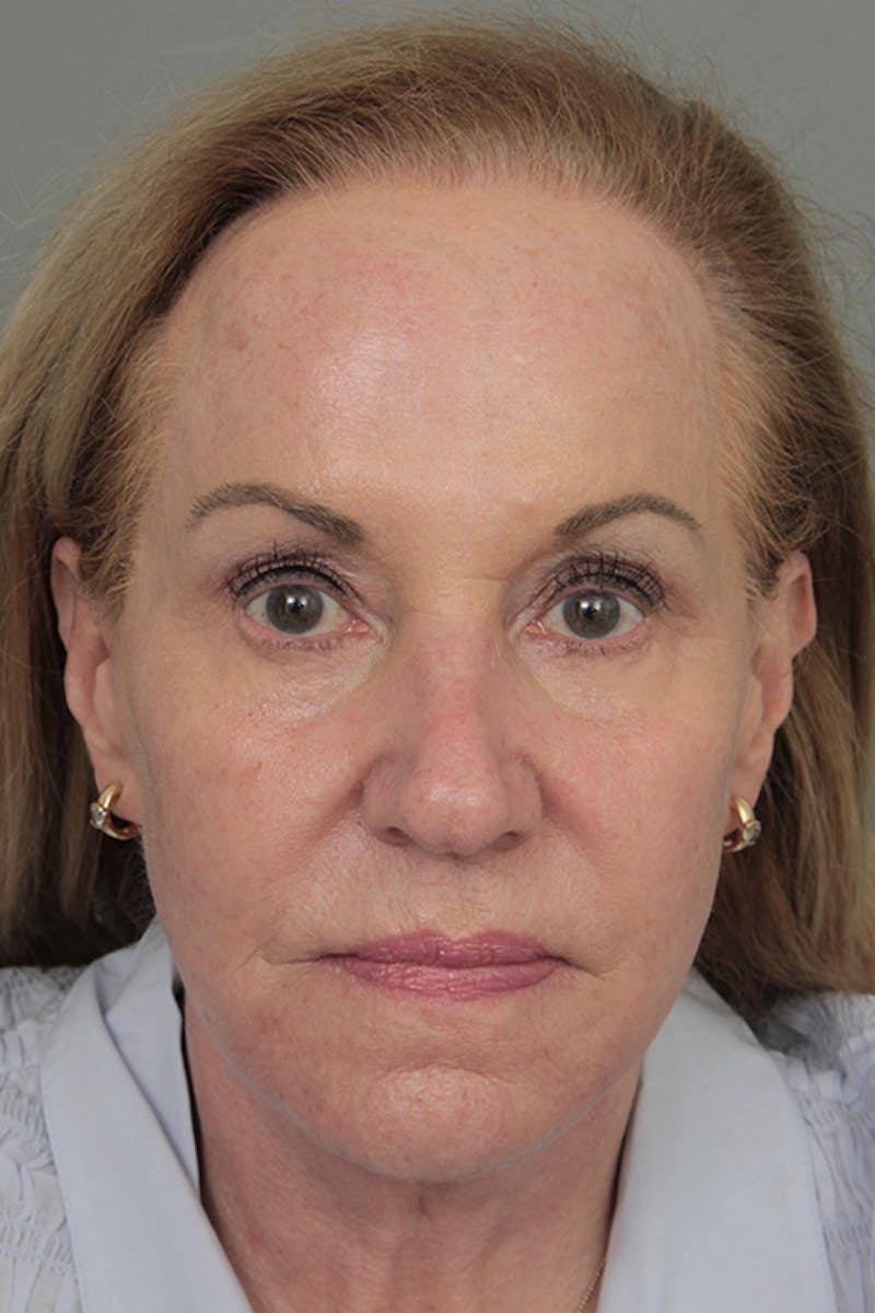 Facelift | Neck Lift Before & After Gallery - Patient 326379 - Image 4 - Scott Chapin, MD