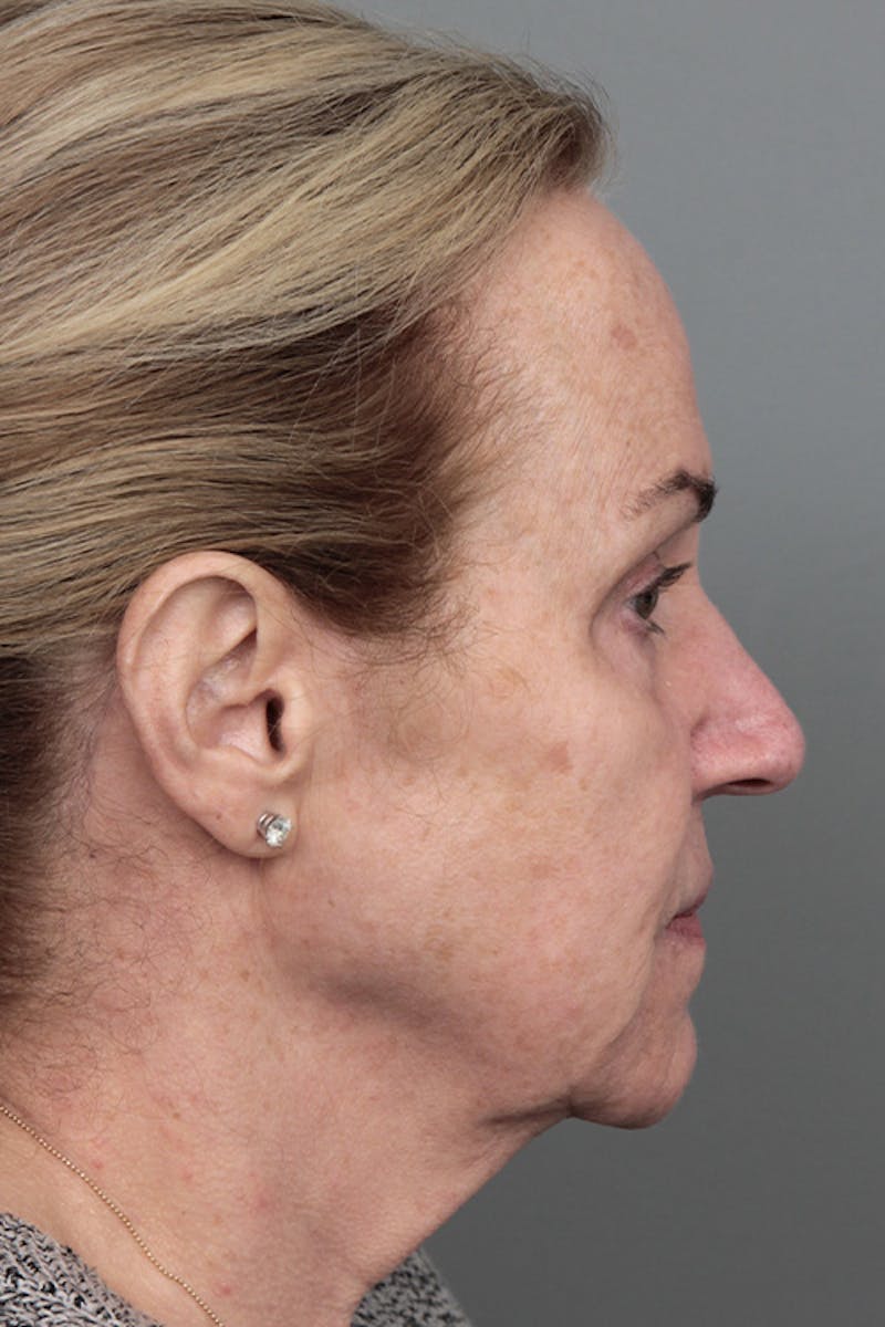 Facelift | Neck Lift Before & After Gallery - Patient 326379 - Image 5 - Scott Chapin, MD