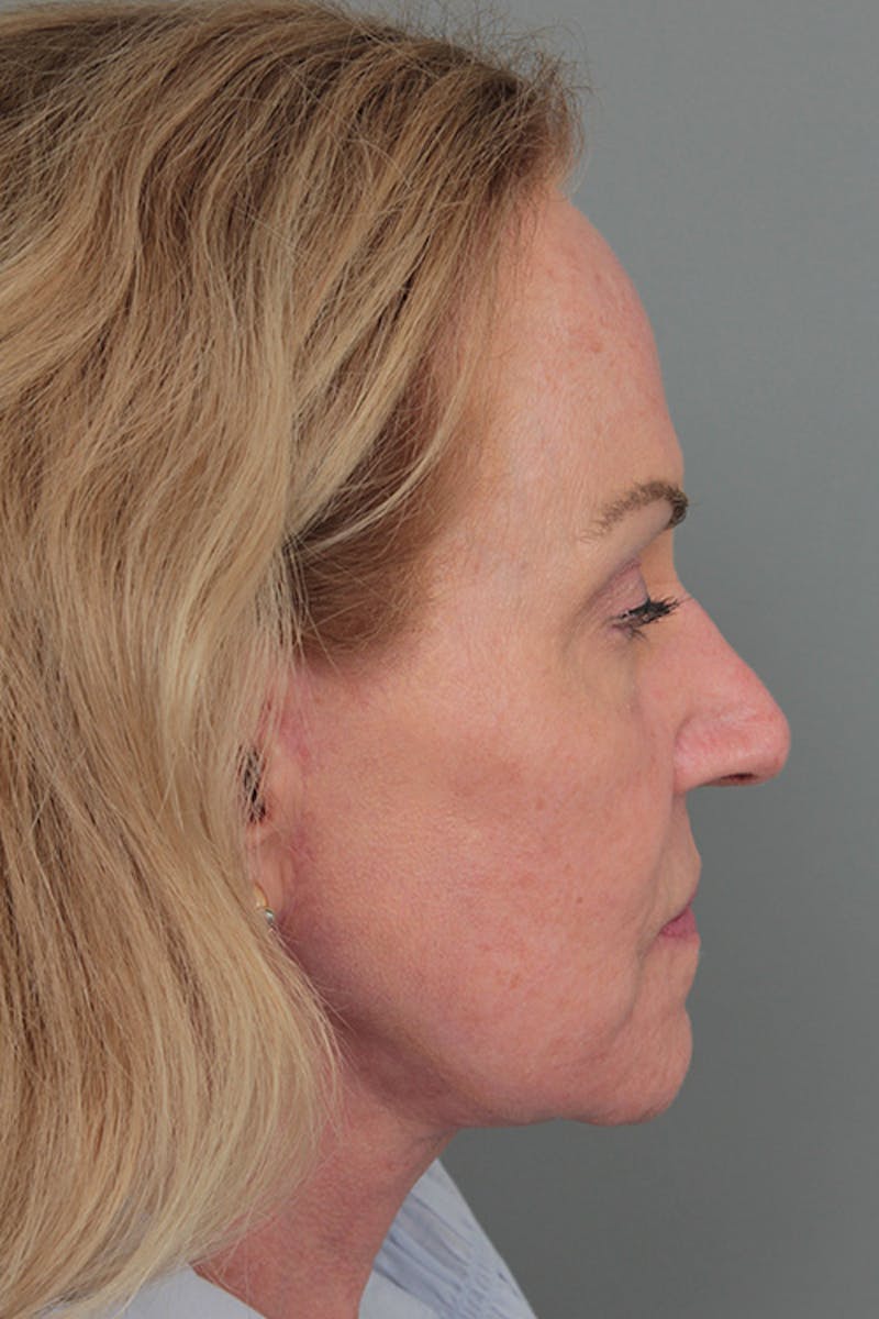 Facelift | Neck Lift Before & After Gallery - Patient 326379 - Image 6 - Scott Chapin, MD