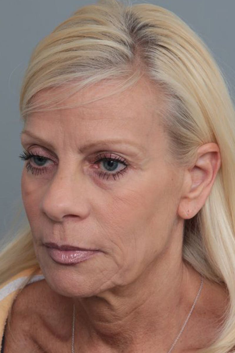 Facelift | Neck Lift Before & After Gallery - Patient 115097 - Image 1 - Scott Chapin, MD