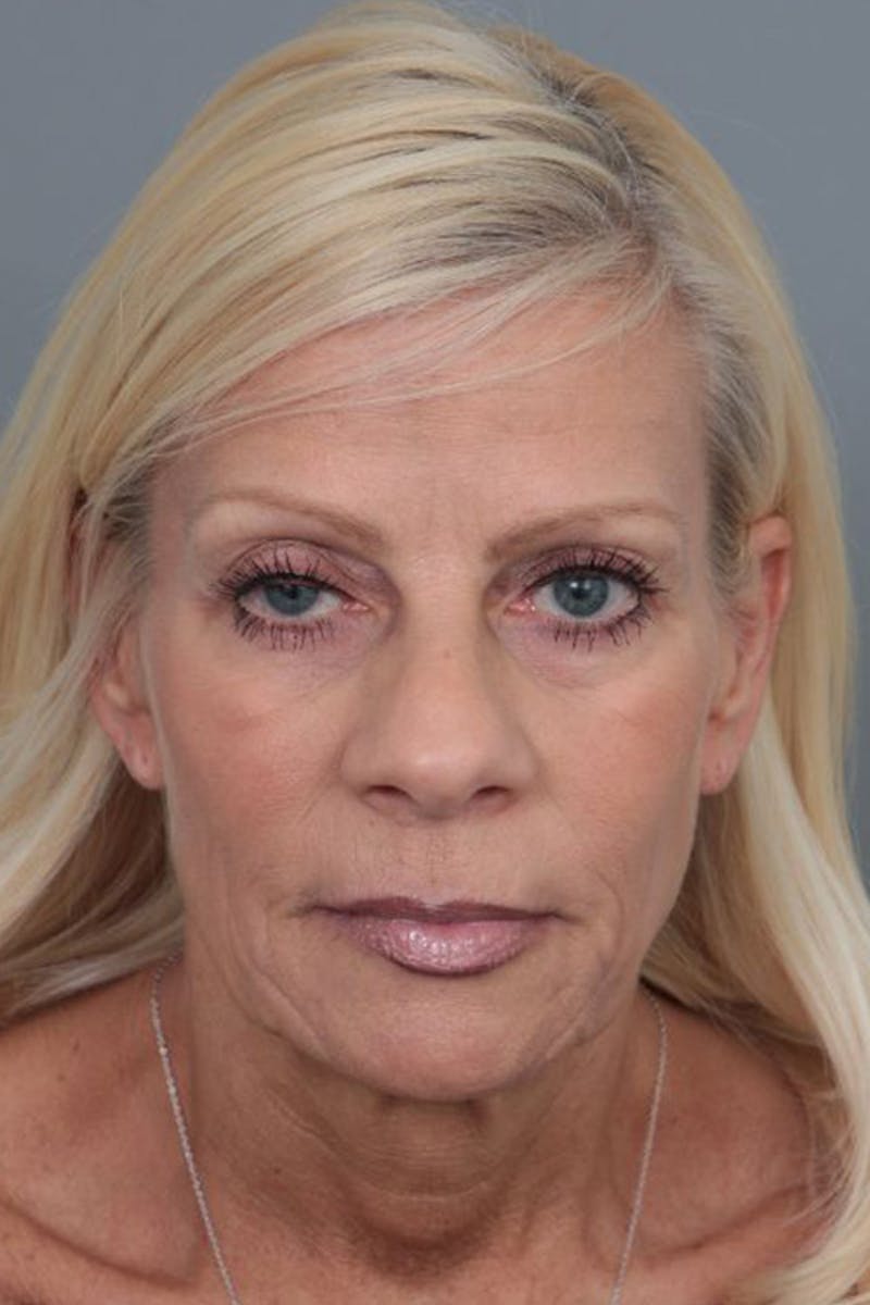 Facelift | Neck Lift Before & After Gallery - Patient 115097 - Image 3 - Scott Chapin, MD