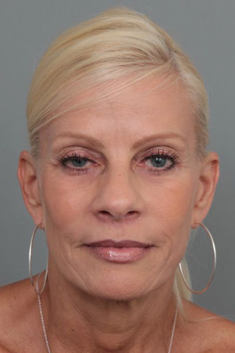 Facelift | Neck Lift Before & After Gallery - Patient 115097 - Image 4 - Scott Chapin, MD