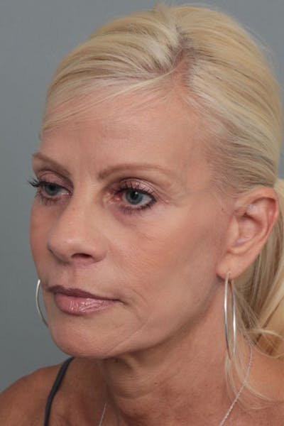 Facelift | Neck Lift Before & After Gallery - Patient 115097 - Image 2 - Scott Chapin, MD