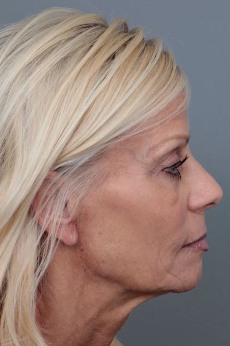 Facelift | Neck Lift Before & After Gallery - Patient 115097 - Image 5 - Scott Chapin, MD