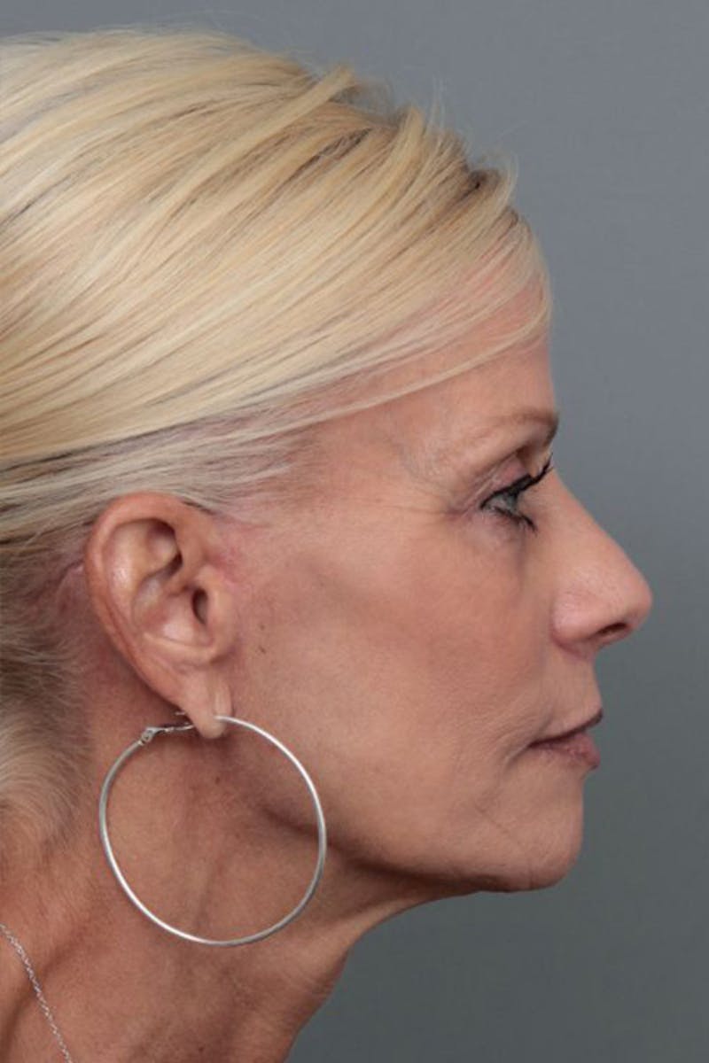 Facelift | Neck Lift Before & After Gallery - Patient 115097 - Image 6 - Scott Chapin, MD