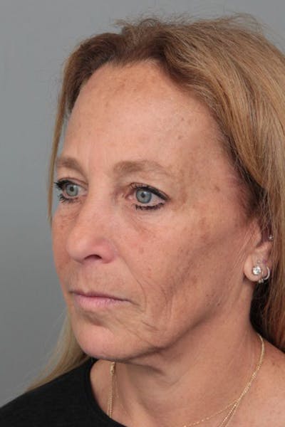 Facelift | Neck Lift Before & After Gallery - Patient 251002 - Image 1 - Scott Chapin, MD