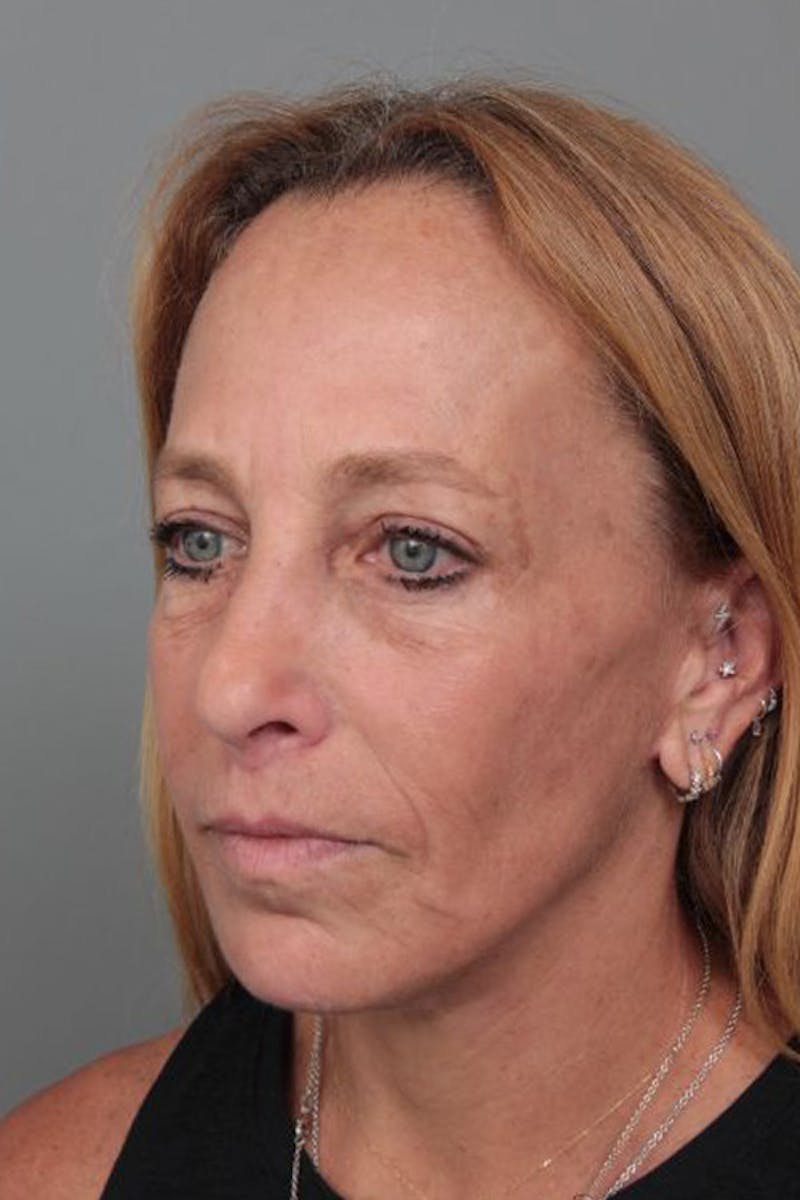 Facelift | Neck Lift Before & After Gallery - Patient 251002 - Image 2 - Scott Chapin, MD