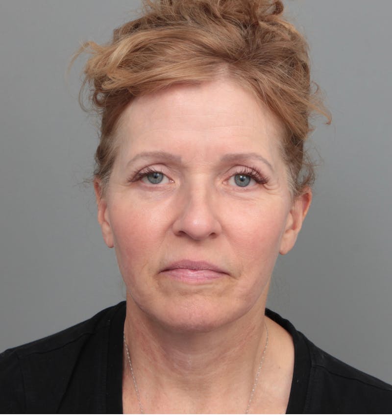Facelift | Neck Lift Before & After Gallery - Patient 385022 - Image 4 - Scott Chapin, MD