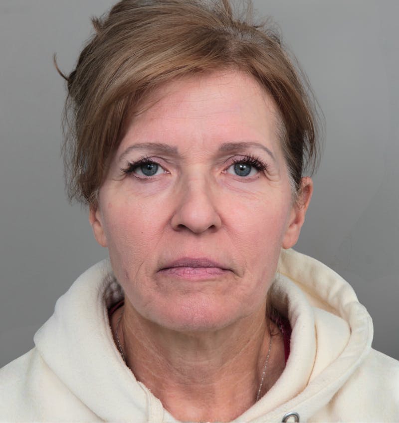 Facelift | Neck Lift Before & After Gallery - Patient 385022 - Image 3 - Scott Chapin, MD