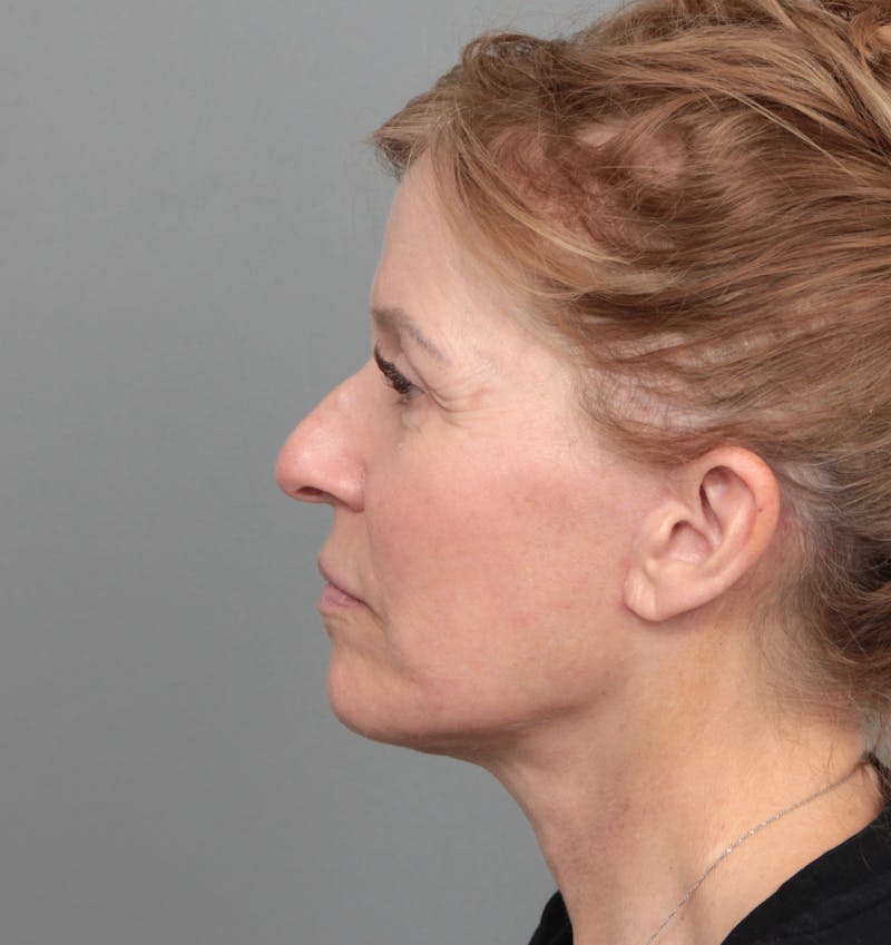 Facelift | Neck Lift Before & After Gallery - Patient 385022 - Image 6 - Scott Chapin, MD