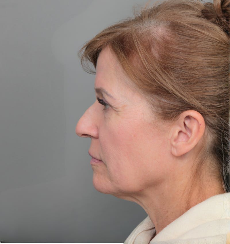Facelift | Neck Lift Before & After Gallery - Patient 385022 - Image 5 - Scott Chapin, MD