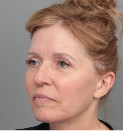 Facelift | Neck Lift Before & After Gallery - Patient 385022 - Image 2 - Scott Chapin, MD