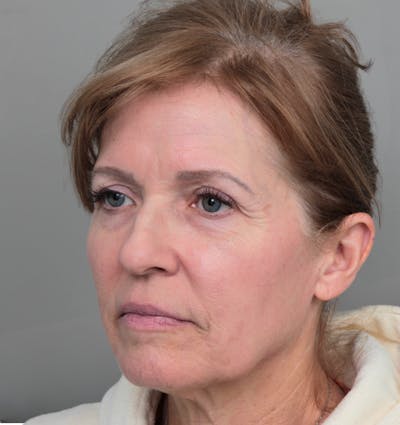 Facelift | Neck Lift Before & After Gallery - Patient 385022 - Image 1 - Scott Chapin, MD